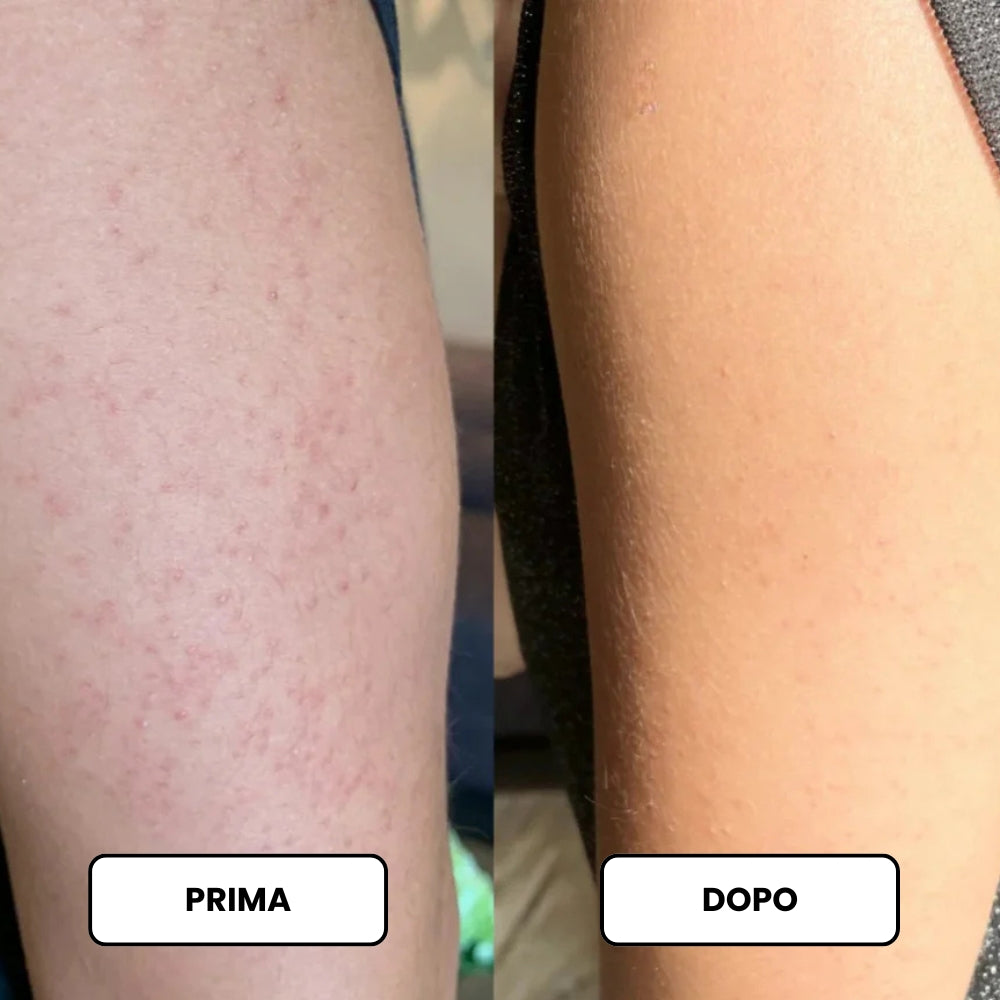 Crema Levigante a Tripla Azione per la Cheratosi Pilare