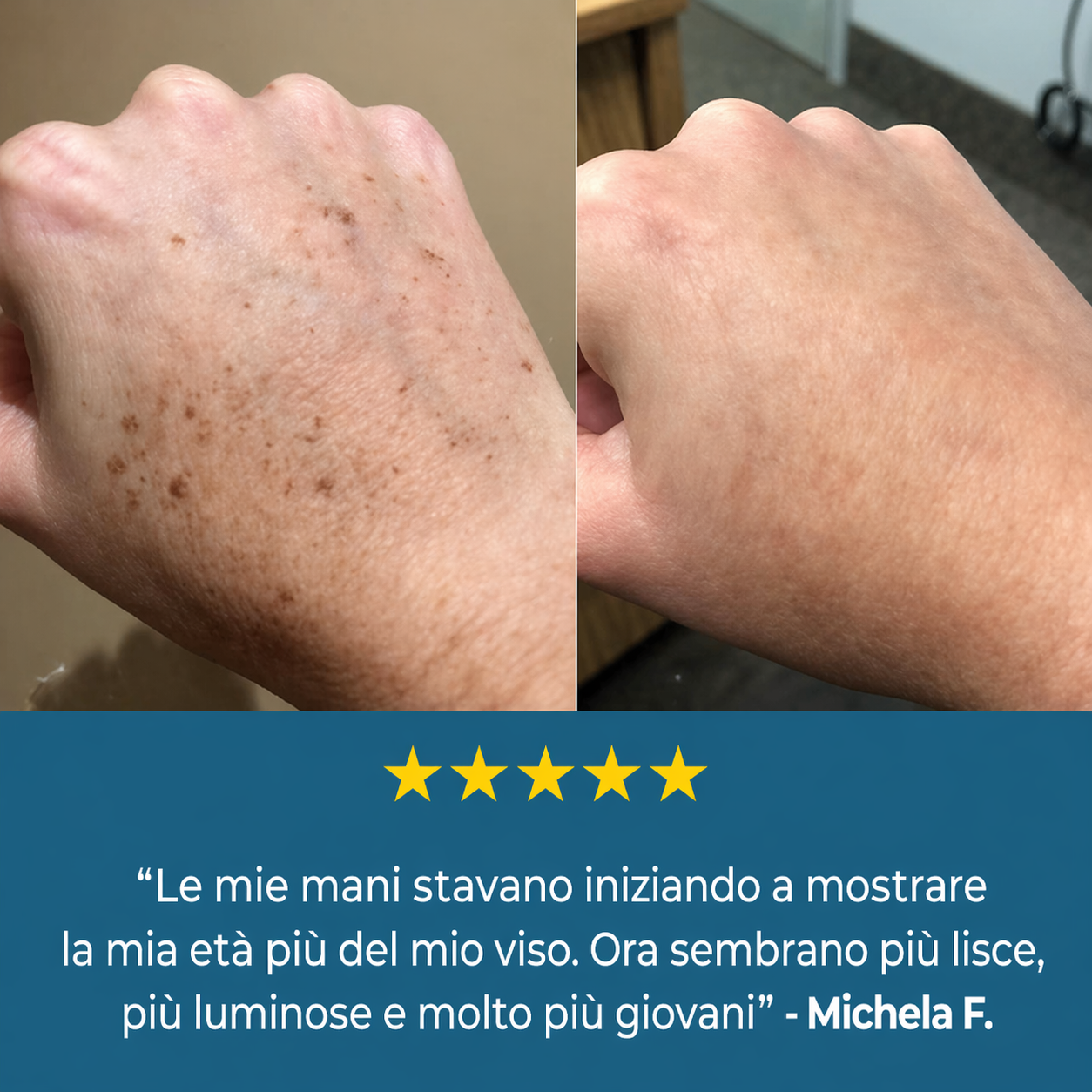 SoftBliss™ Crema per macchie dell'età | Riduci le macchie scure del 93% in 7 giorni