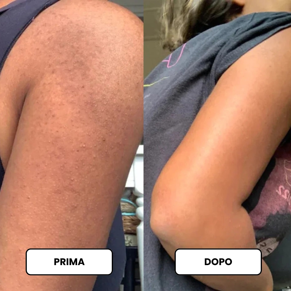 Crema Levigante a Tripla Azione per la Cheratosi Pilare