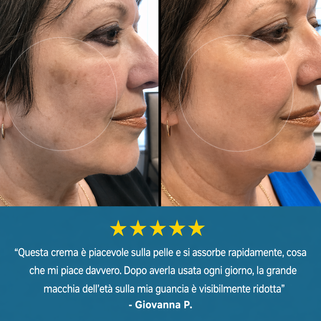 SoftBliss™ Crema per macchie dell'età | Riduci le macchie scure del 93% in 7 giorni